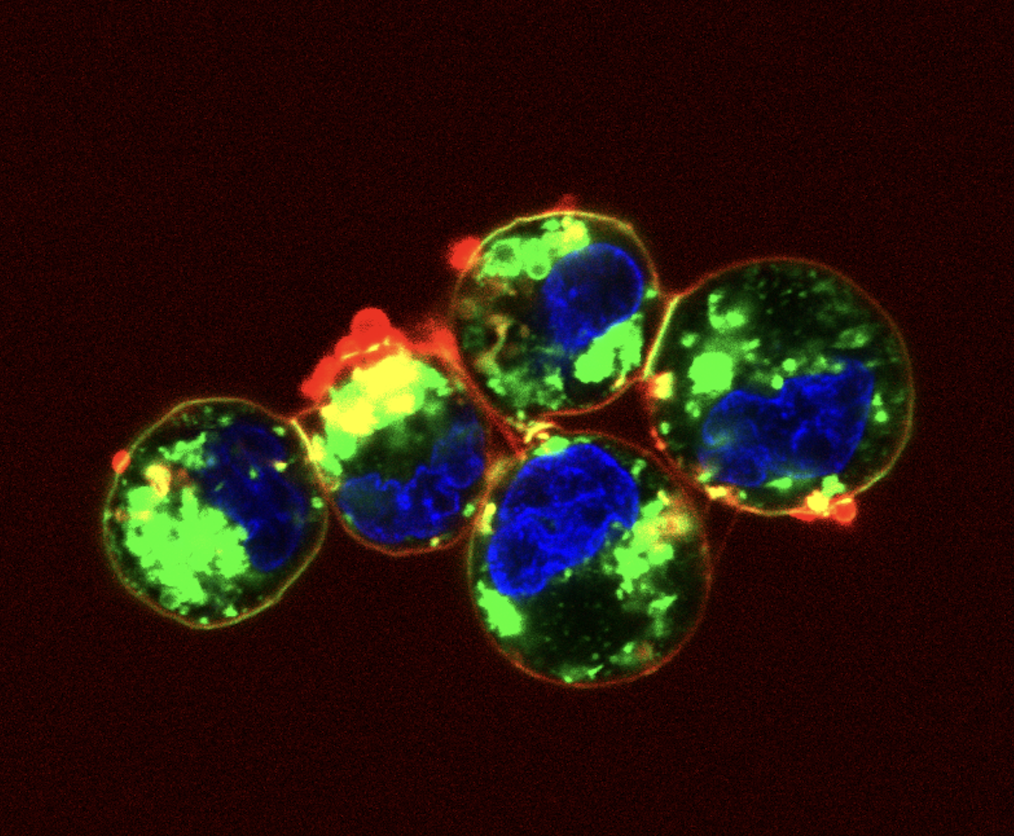 Blebbing observed in breast cancer cell line